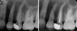endodontic_treatment_dr_semez